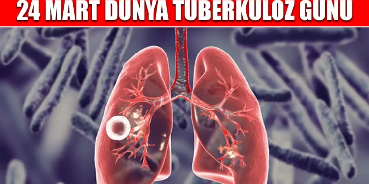 Sağlık Bakanlığı’ndan Dünya Tüberküloz Günü açıklaması