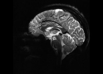 Yapay zeka, epilepsili çocuklarda doktorların gözden kaçırdığı gizli lezyonları buldu