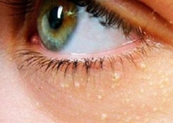 Kalp krizi ve inme riskine işaret eden yüzdeki sarı lekeler: Ksantalazma